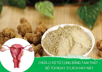 Chữa u xơ tử cung bằng tam thất - Bỏ túi ngay 3 cách hay này